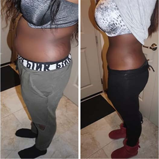 User showing reduced bloating in side-by-side photos after using Flat Tummy Co. supplements.